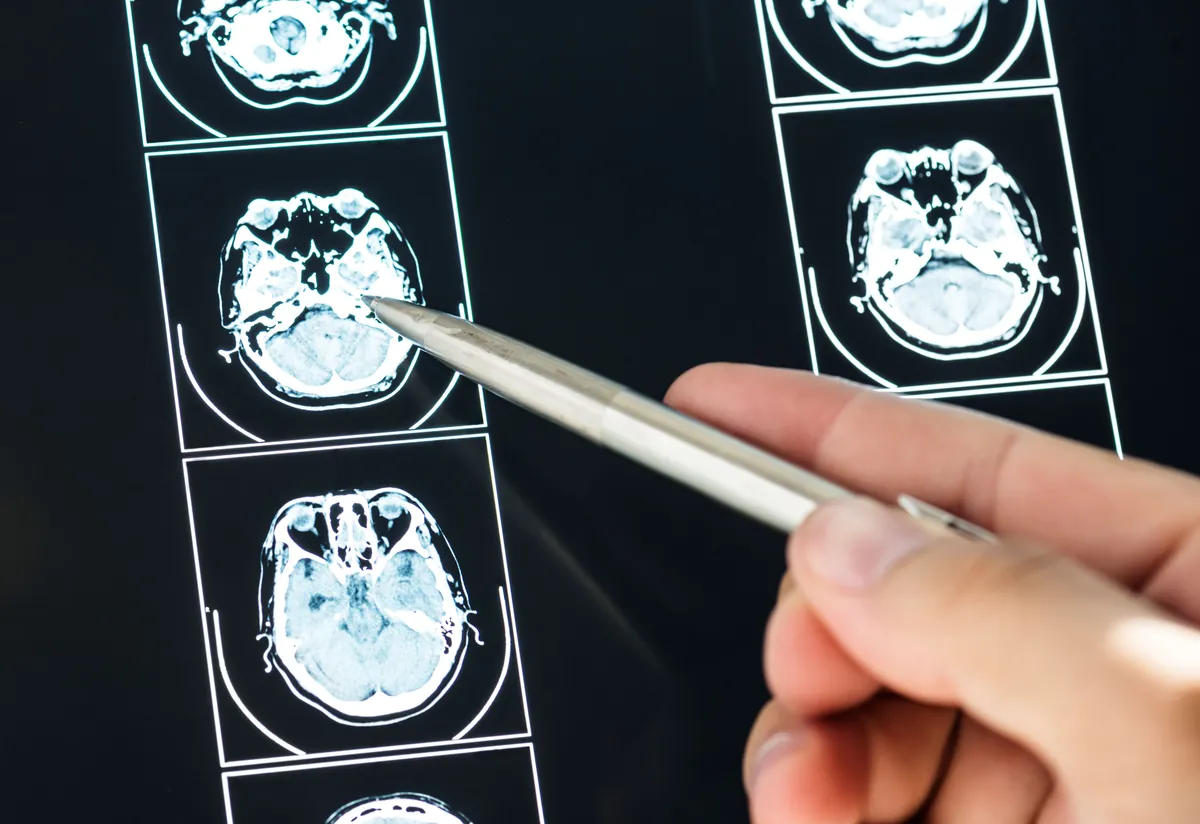Brain MRI images being reviewed